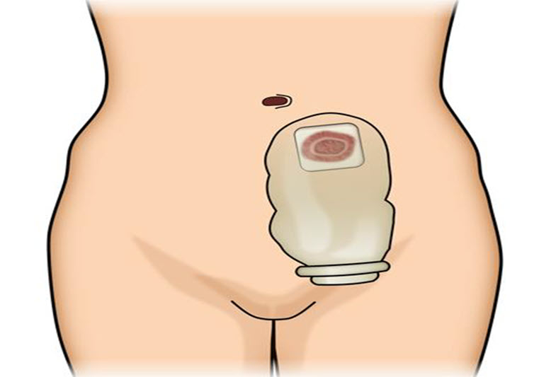 أوستومی (Ostomy)